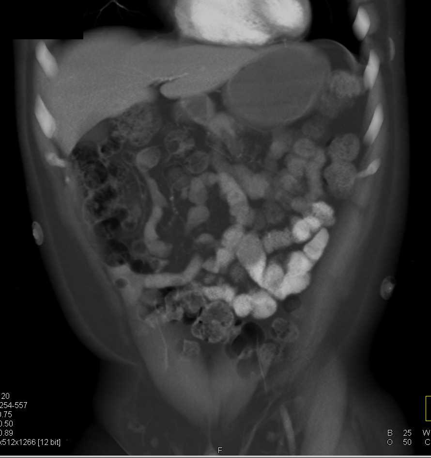 2 cm Small Bowel GIST Tumor - CTisus CT Scan