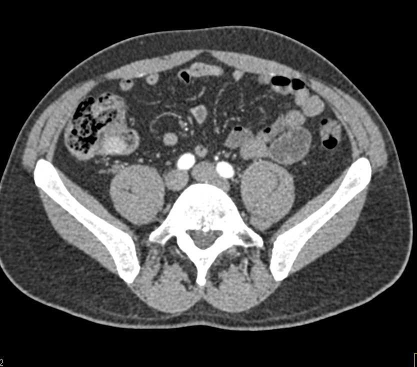 Carcinoid Tumor in the Terminal Ileum - CTisus CT Scan