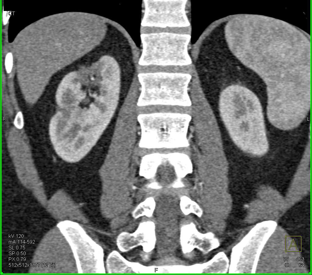 Carcinoid Tumor in the Terminal Ileum with Scarring the Upper Pole Right Kidney - CTisus CT Scan