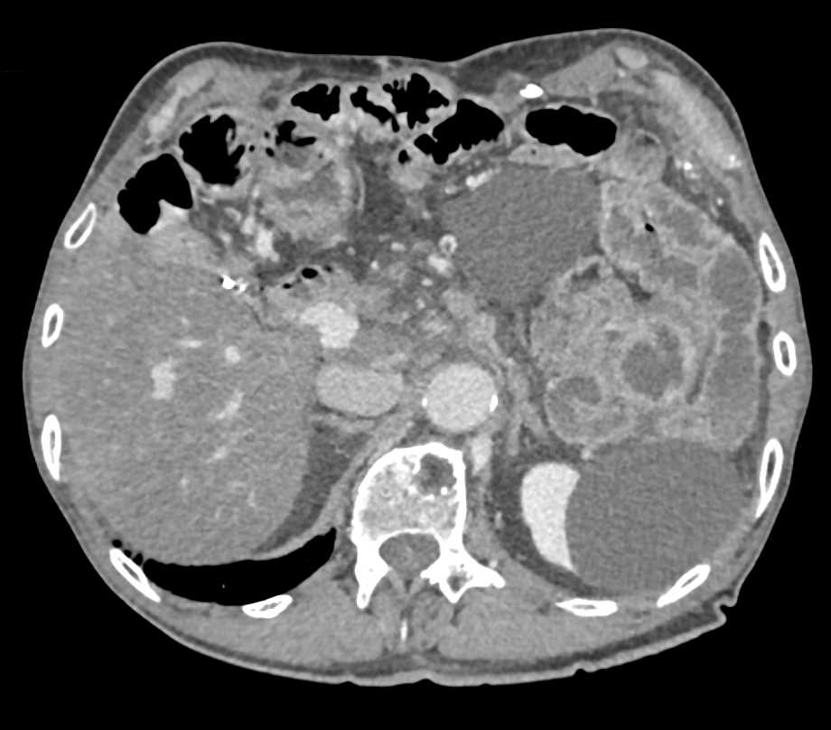 Right Internal Hernia Through Inguinal Ring with Small Bowel Obstruction - CTisus CT Scan