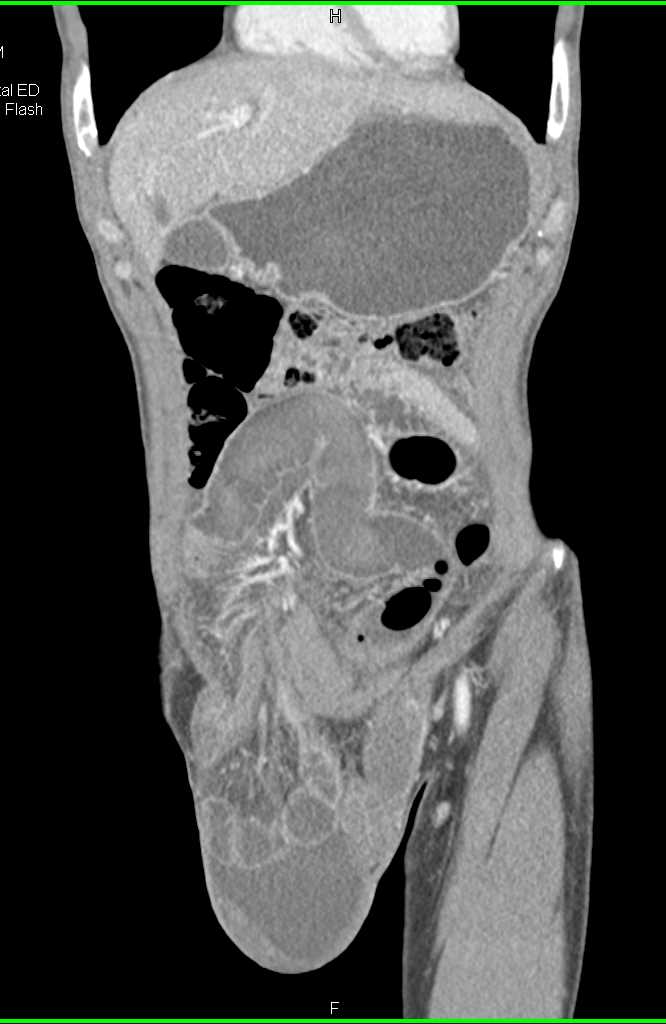 Right Internal Hernia Through Inguinal Ring with Small Bowel Obstruction - CTisus CT Scan