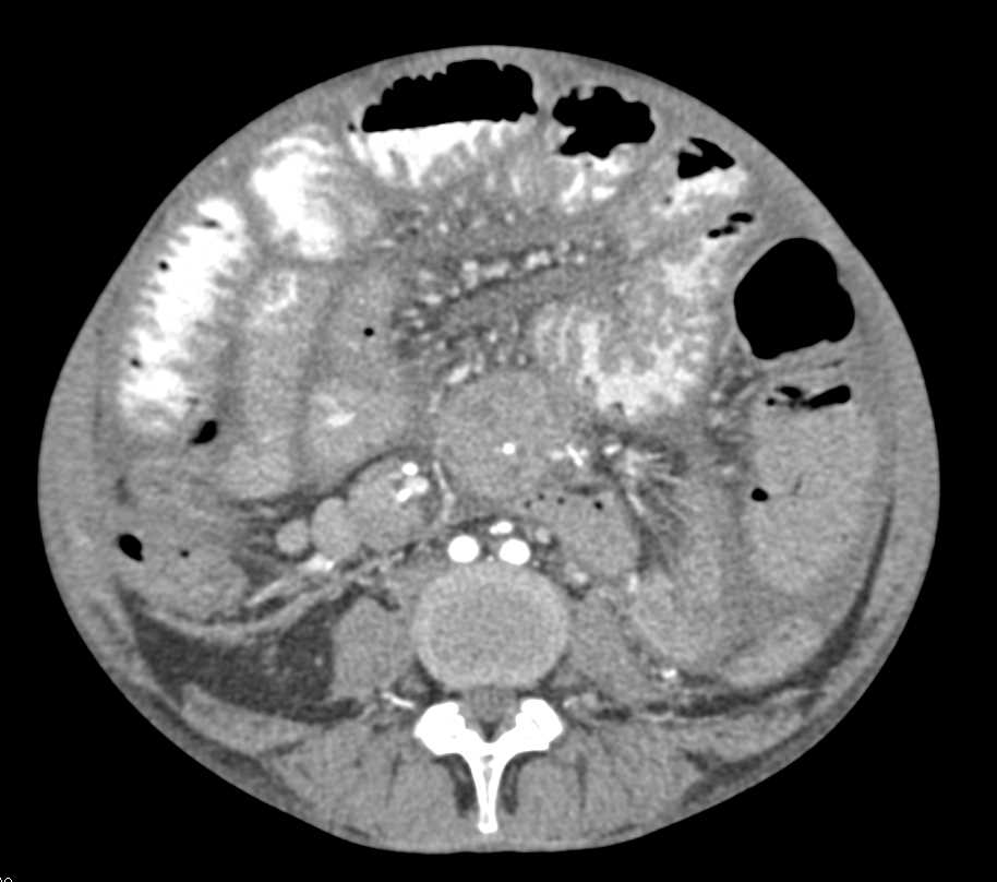 Thickened Small Bowel Secondary with Mycobacterium avium/intracellulare (MAI) Infection - CTisus CT Scan