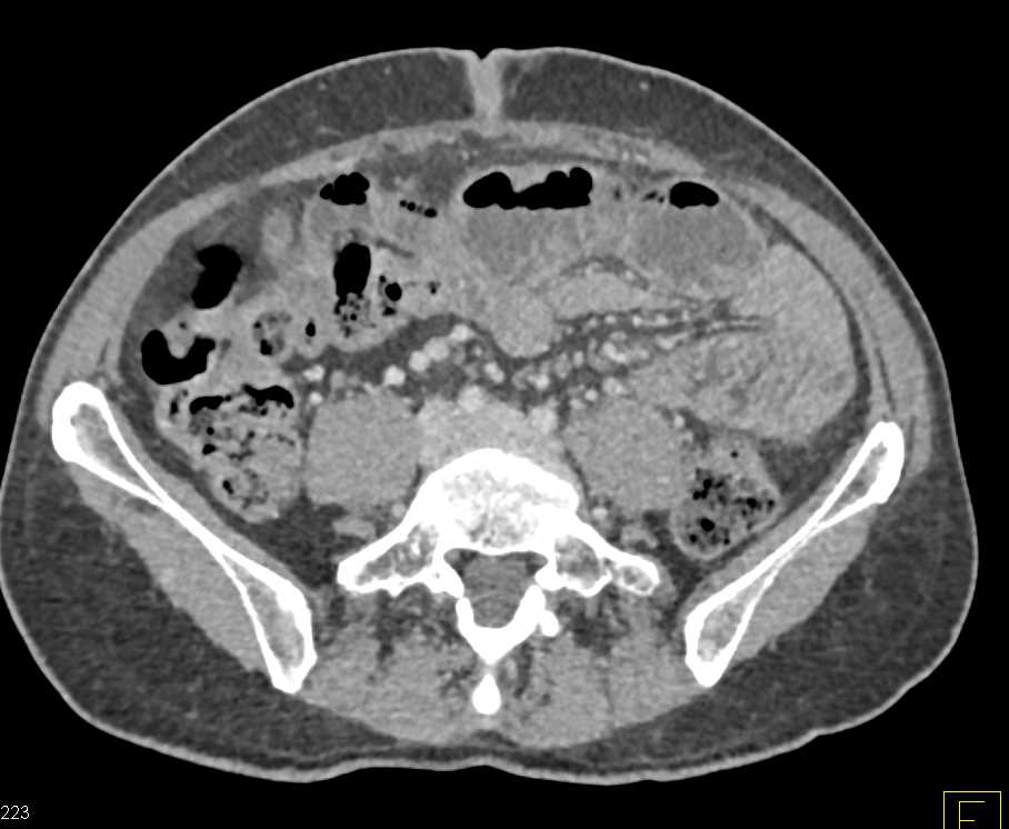 Small Bowel Obstruction (SBO) due to Distal Tumor Implants - CTisus CT Scan