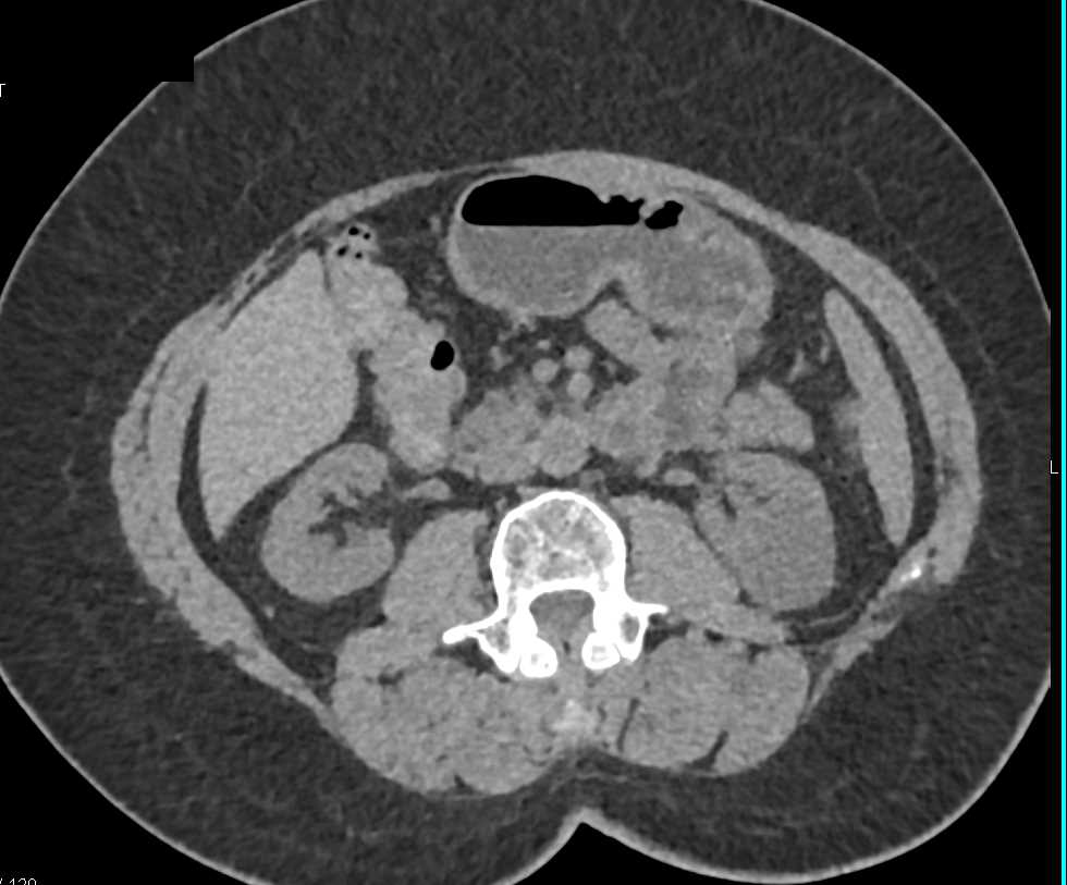 Vasculitis with Superior Mesenteric Artery (SMA) Involvement and Branches - CTisus CT Scan