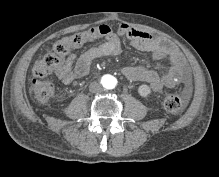Active Bleed in Jejunum - CTisus CT Scan