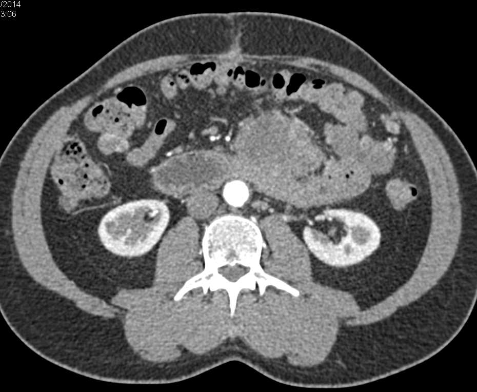 Small Bowel Carcinoid Tumor - Small Bowel Case Studies - CTisus CT Scanning