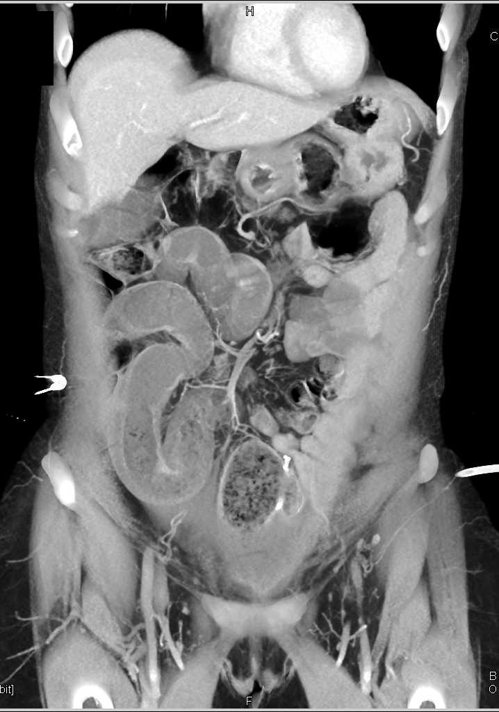 SBO with Feces Sign and Recurrent Colon Cancer Obstruction - Small ...