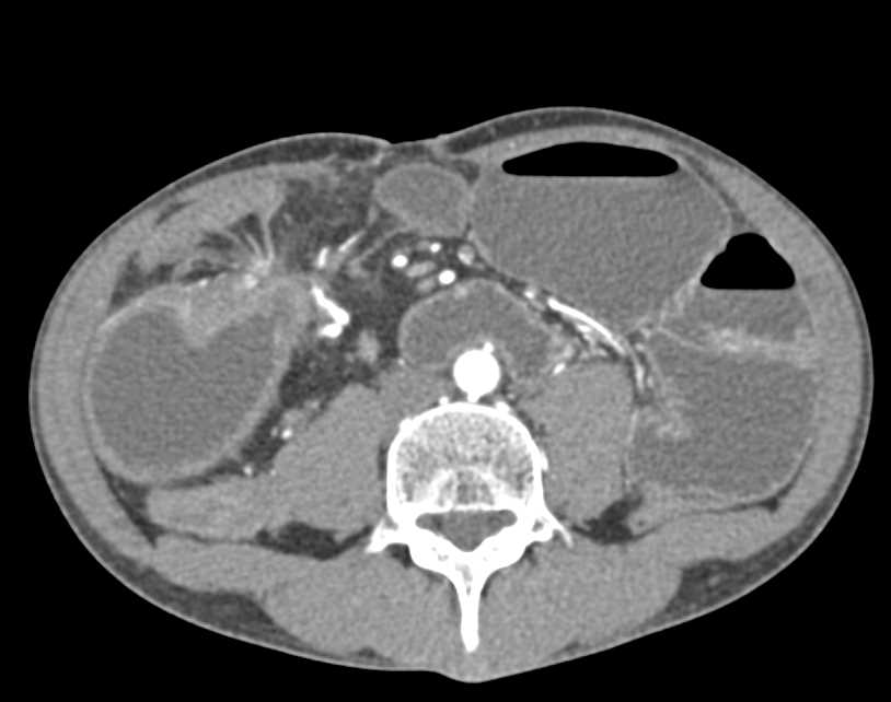 Small Bowel Obstruction (SBO) due to Crohn's Disease - CTisus CT Scan