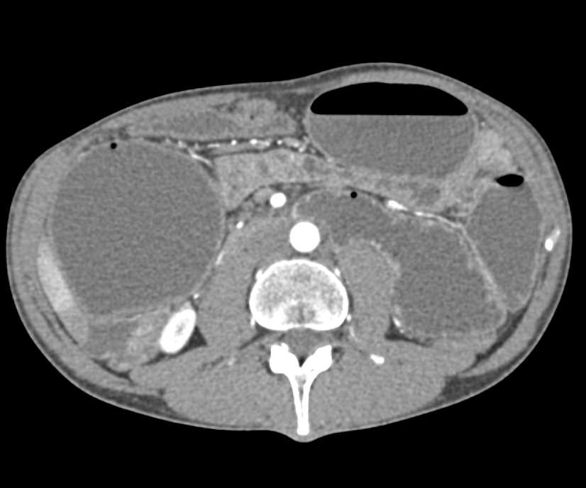 Crohn's Disease with Specific Vascular Map - CTisus CT Scan