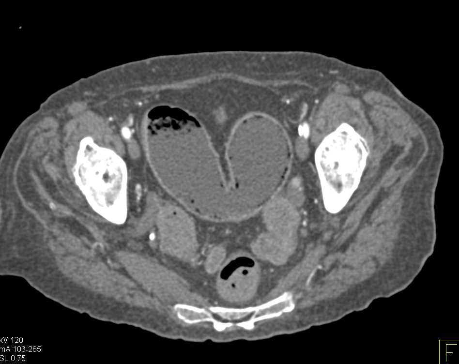 Pneumatosis Small Bowel c/w Ischemic Bowel vs Crohn's - CTisus CT Scan