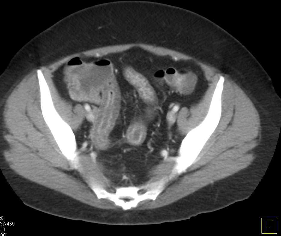 Graft vs Host Disease in Small Bowel - CTisus CT Scan