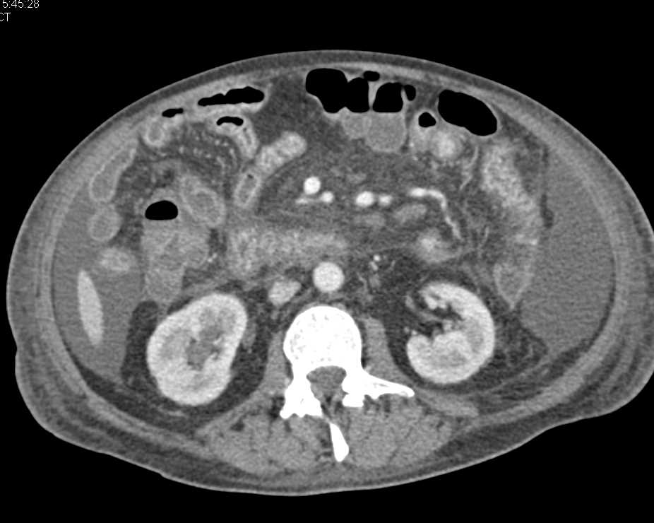 Colitis Involving the Small Bowel - CTisus CT Scan