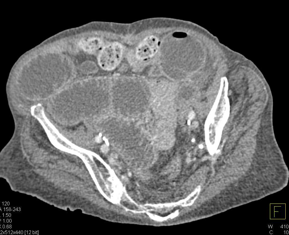 Small Bowel Obstruction (SBO) due to Adhesions - CTisus CT Scan