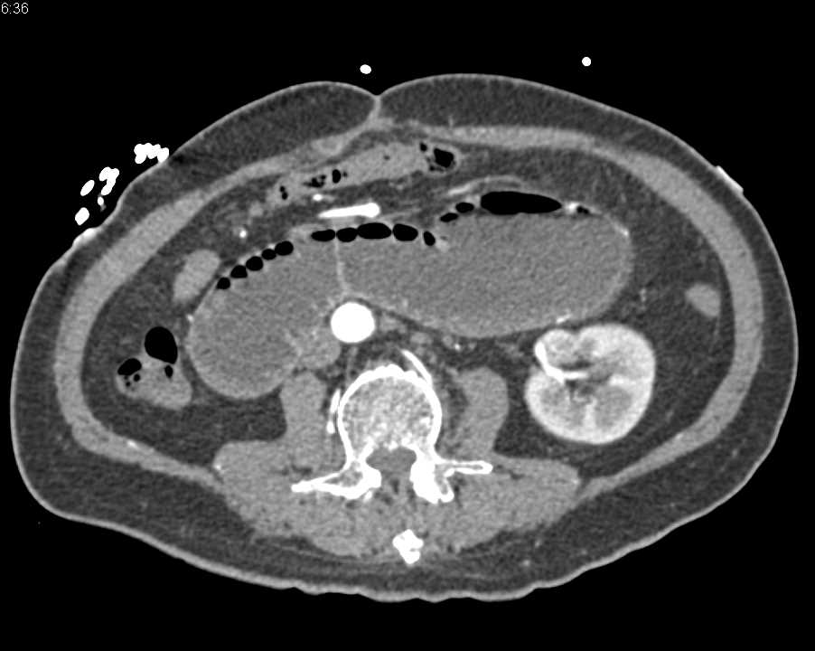 Small Bowel Obstruction (SBO) in the Distal Small Bowel - Small Bowel ...