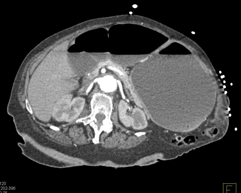 Small Bowel Obstruction (SBO) with Perforation - CTisus CT Scan