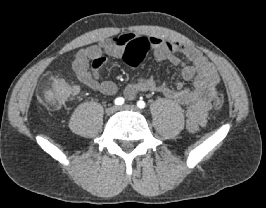 Crohn's Disease ileum and Cecum with Stricture - CTisus CT Scan