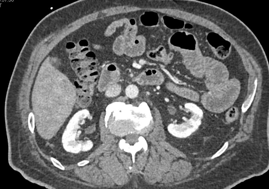 Duodenal Carcinoma Involving the Ampullary Region - CTisus CT Scan
