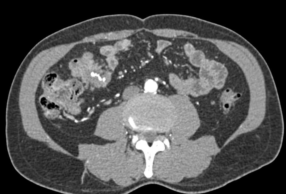 Recurrent Small Bowel Carcinoid Tumor - CTisus CT Scan
