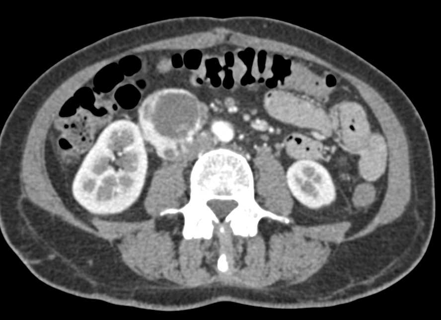 Duodenal GIST Tumor - CTisus CT Scan