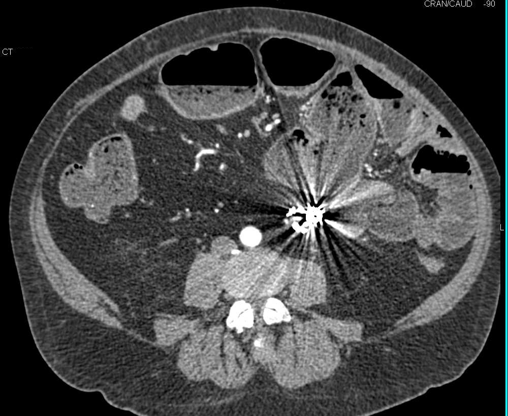 Small Bowel Obstruction (SBO) due to Adhesions - CTisus CT Scan