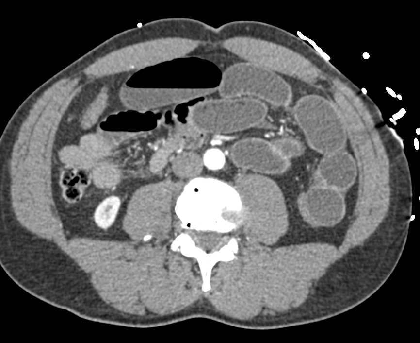 Small Bowel Obstruction due to Adhesions - CTisus CT Scan