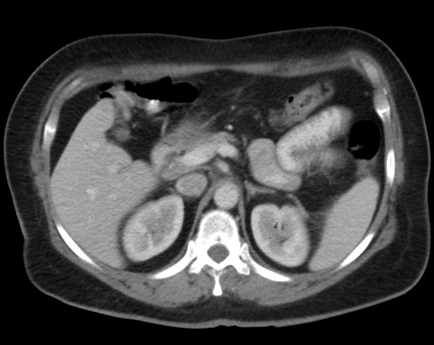 Hemorrhage in the Jejunum with Thickened Folds - CTisus CT Scan