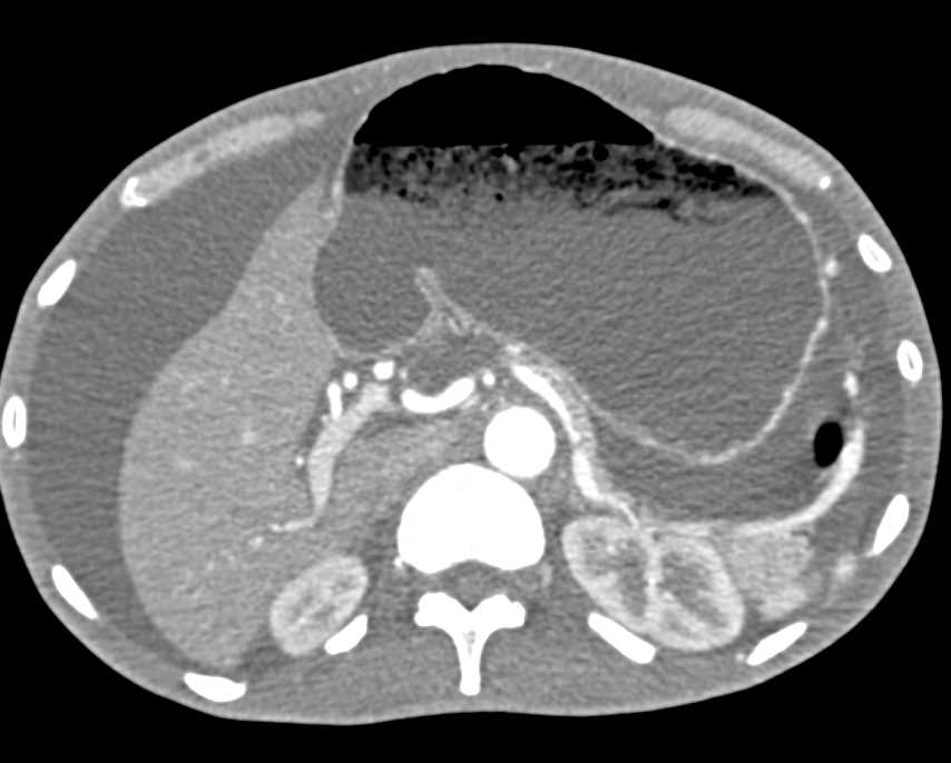 Small Bowel Obstruction (SBO) with Carcinomatosis - CTisus CT Scan
