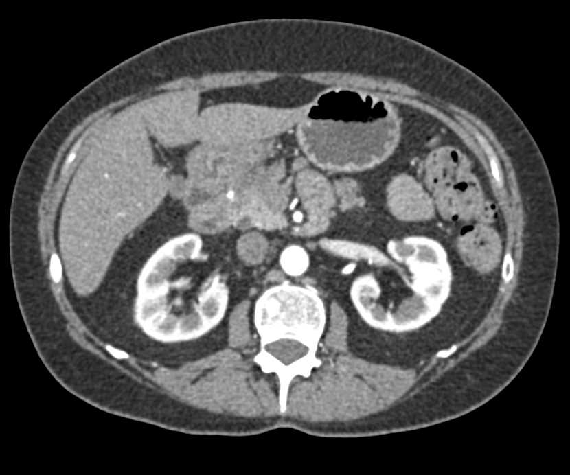 Crohn's Disease in Cecum and Ileum - CTisus CT Scan