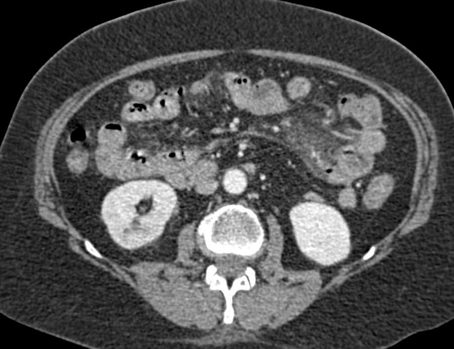 Inflammation Jejunum with Mesenteric Infiltration - CTisus CT Scan