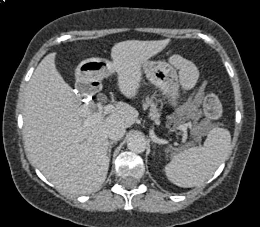 Inflammation Jejunum with Mesenteric Infiltration - CTisus CT Scan