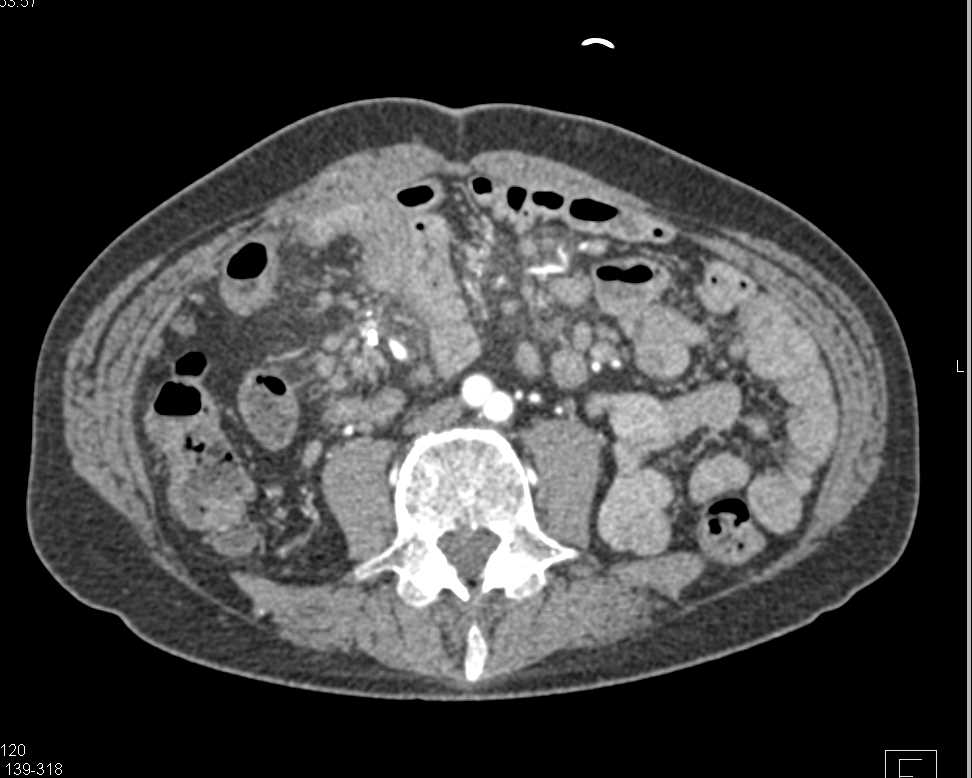 Small Bowel Enteritis with Thickened Bowel and Mesentery - CTisus CT Scan