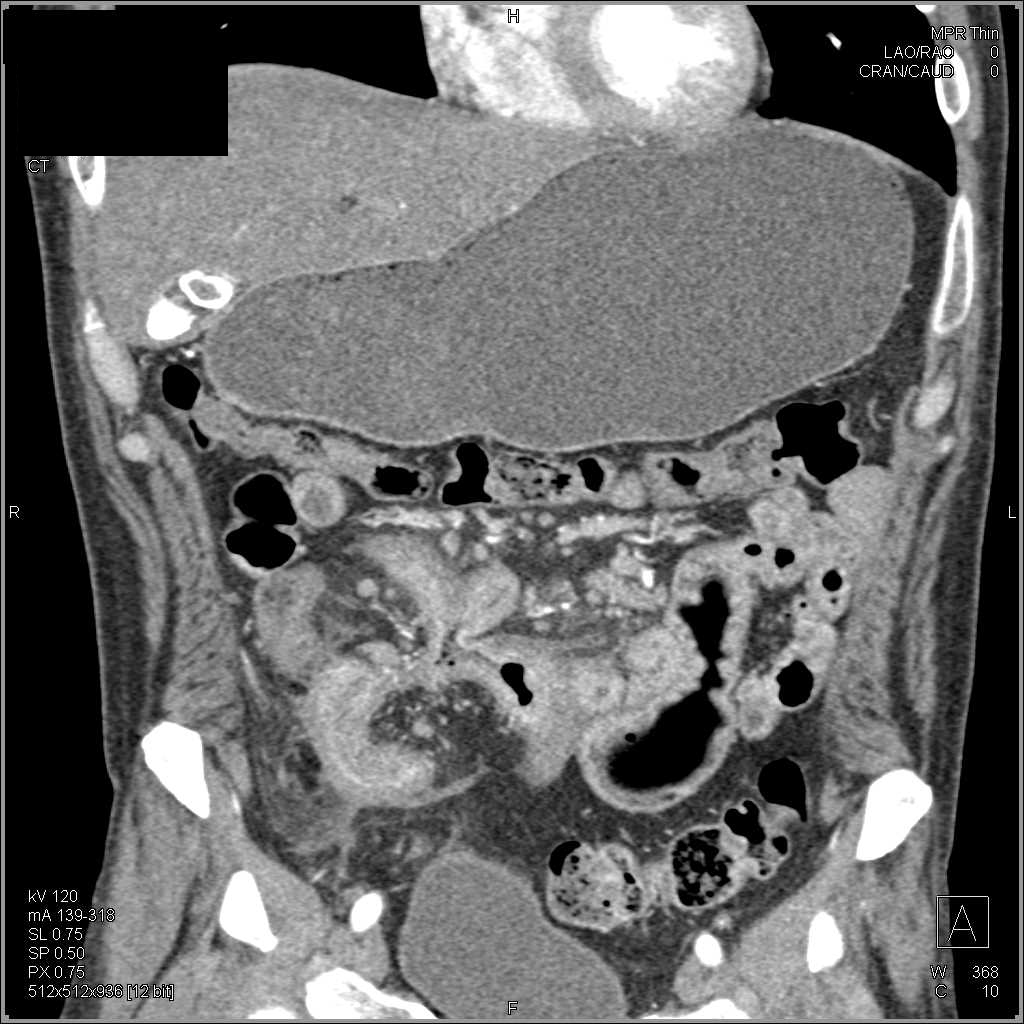 Crohn's Disease with Small Bowel Fistulae - CTisus CT Scan