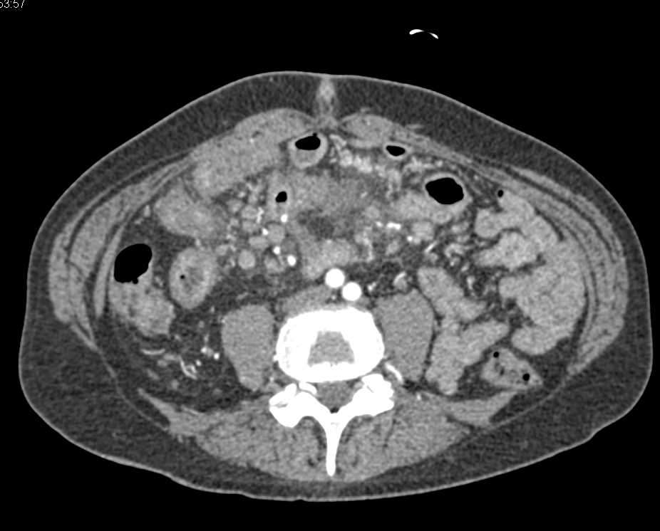 Crohn's Disease with Small Bowel Fistulae - CTisus CT Scan