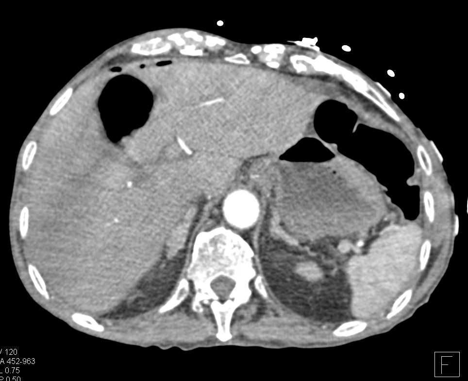 Small Bowel Obstruction (SBO) due to Inguinal Hernia with Pneumoperitoneum - CTisus CT Scan