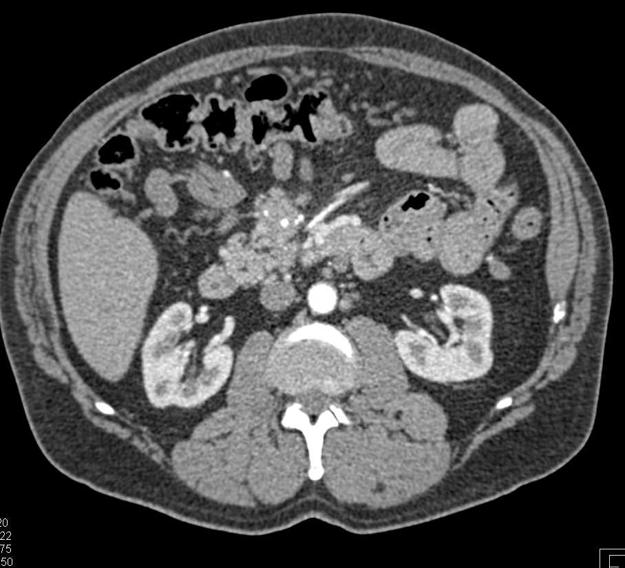 Carcinoid Tumor Encases the SMA - CTisus CT Scan