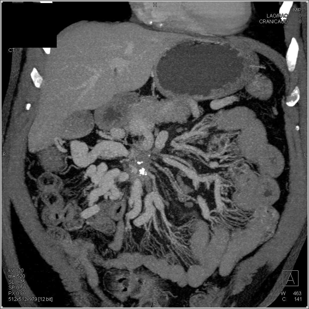 Carcinoid Tumor Encases the Superior Mesenteric Artery (SMA) and Superior Mesenteric Vein (SMV) with Collaterals - CTisus CT Scan