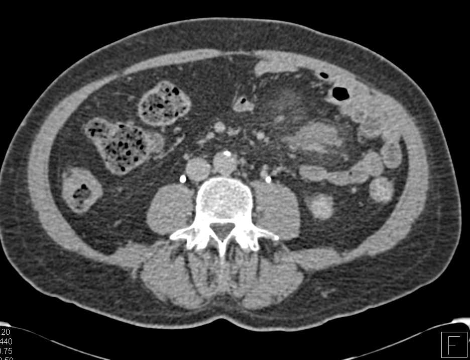 Carcinoid Tumor in Root of the Mesentery - CTisus CT Scan