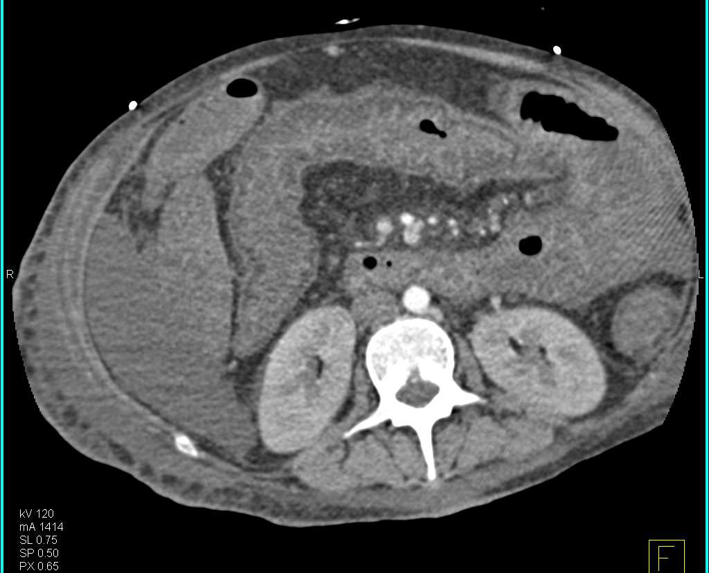 Severe Enteritis Involving the Small Bowel - CTisus CT Scan