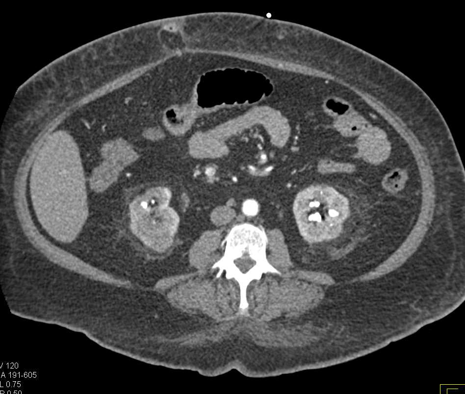 Small Bowel Perforation with Abscess and Renal Infarction - Small Bowel ...