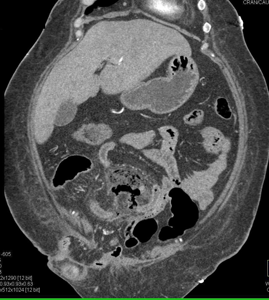 Small Bowel Perforation with Abscess and Renal Infarction - Small Bowel ...