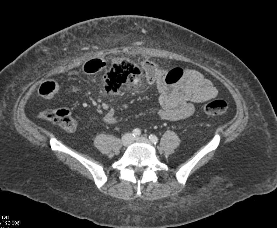 Small Bowel Perforation with Abscess and Renal Infarction - Small Bowel ...