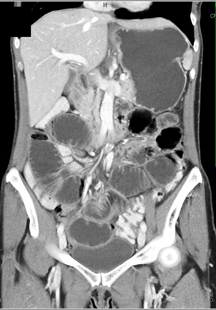 Small Bowel Obstruction (SBO) with Feces Sign - CTisus CT Scan