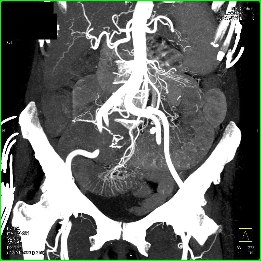 Disease Ileal Loop with Porminent Loops - CTisus CT Scan