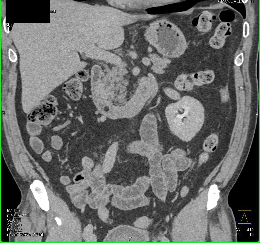 Incidental Duodenal Lipoma - CTisus CT Scan