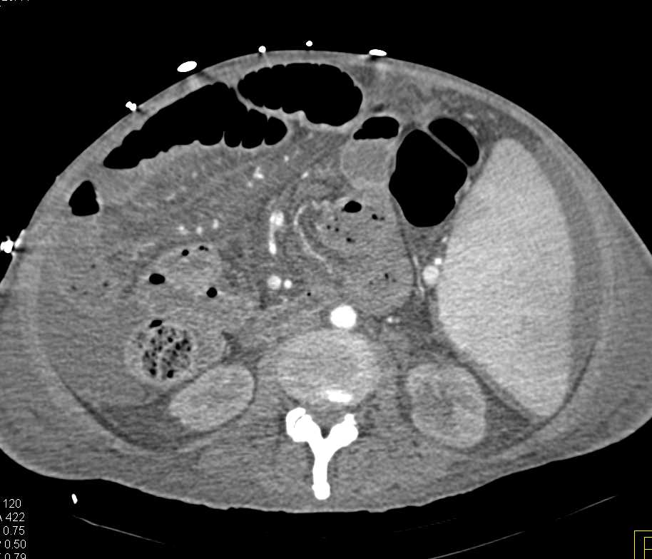 Ischemic Bowel with Halo Sign - CTisus CT Scan