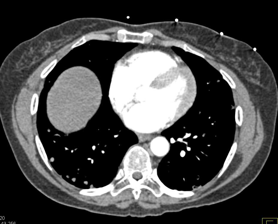 Carcinomatosis with Partial Small Bowel Obstruction - CTisus CT Scan