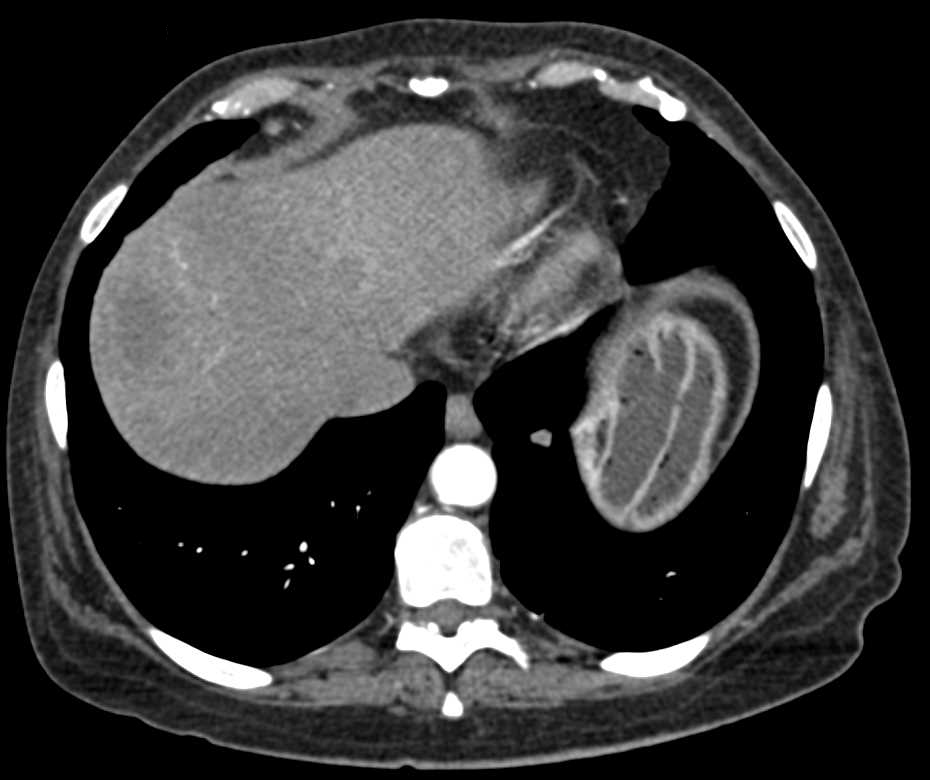 Duodenal Cancer with Stent and PV/SMV clot. - CTisus CT Scan