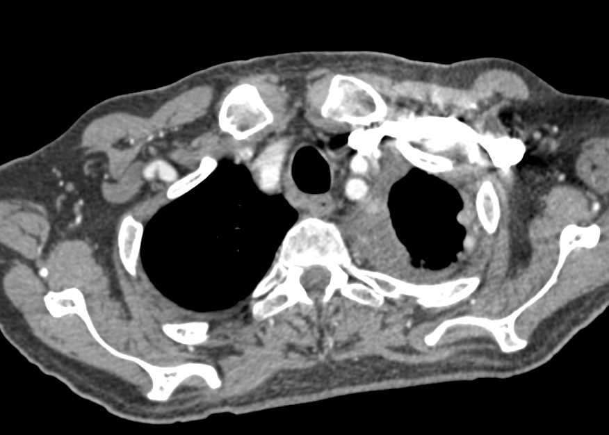 Recurrent Renal Cell Carcinoma with extensive Metastases Especially to the Chest and Now a Distal Small Bowel Obstruction (SBO) due to Hernia - CTisus CT Scan