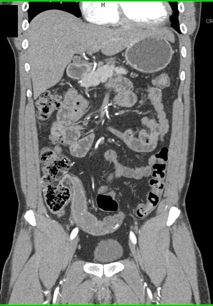 Crohn's Disease with Stricture in Distal Ileum - CTisus CT Scan