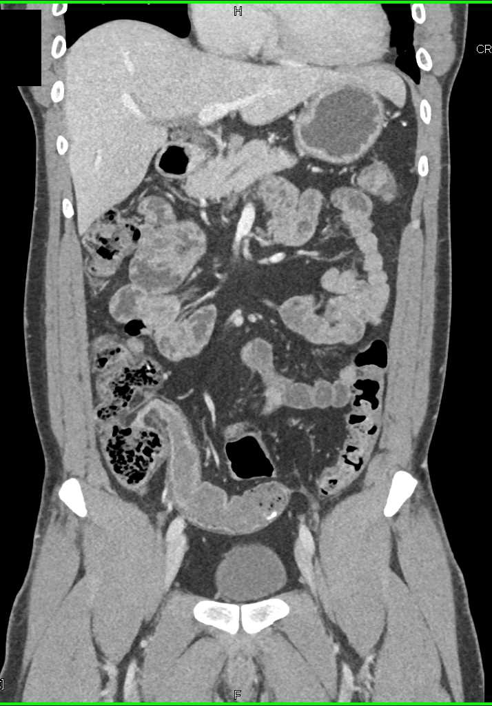 Crohn's Disease with Stricture in Distal Ileum - CTisus CT Scan